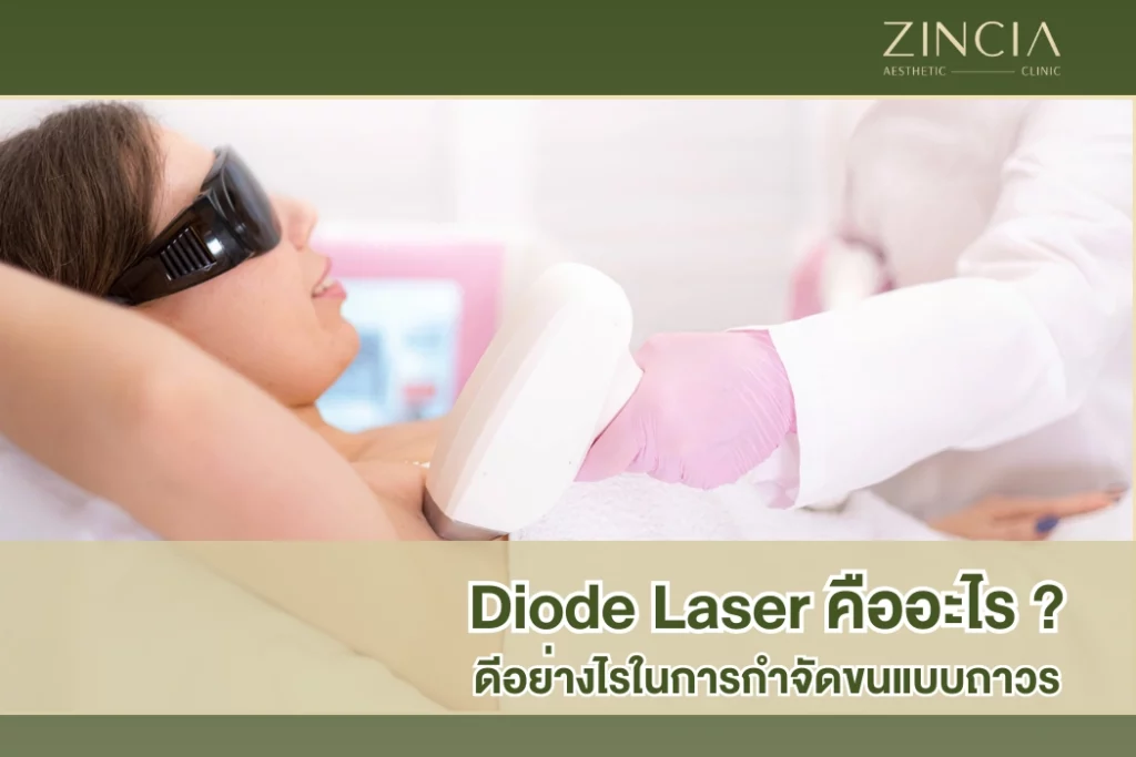 Diode Laser คืออะไร ดีอย่างไรในการกำจัดขนแบบถาวร