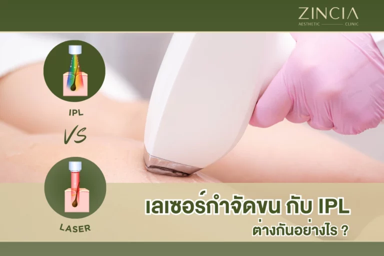 เลเซอร์กำจัดขน กับ IPL ต่างกันอย่างไร ?